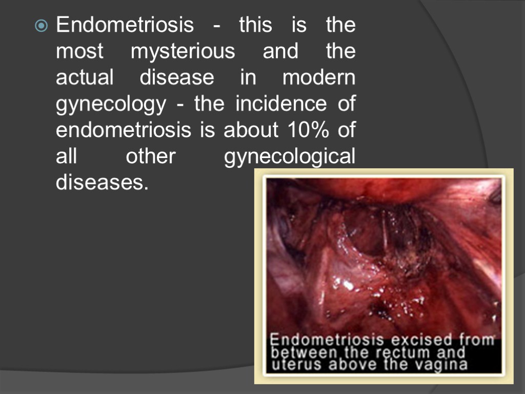 Endometriosis - this is the most mysterious and the actual disease in modern gynecology